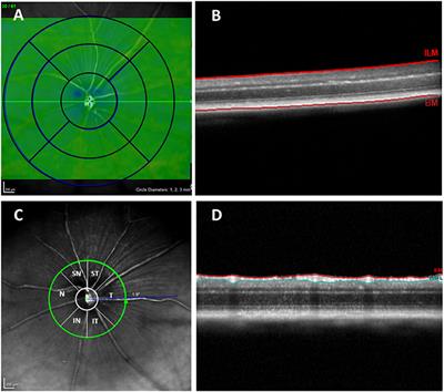 Retinal Thickness Changes Over Time in a Murine AD Model APPNL-F/NL-F